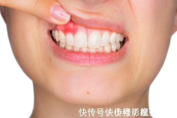 饮水量|肝硬化来临时,通常会有这4种异常,占一个,也要引起注意