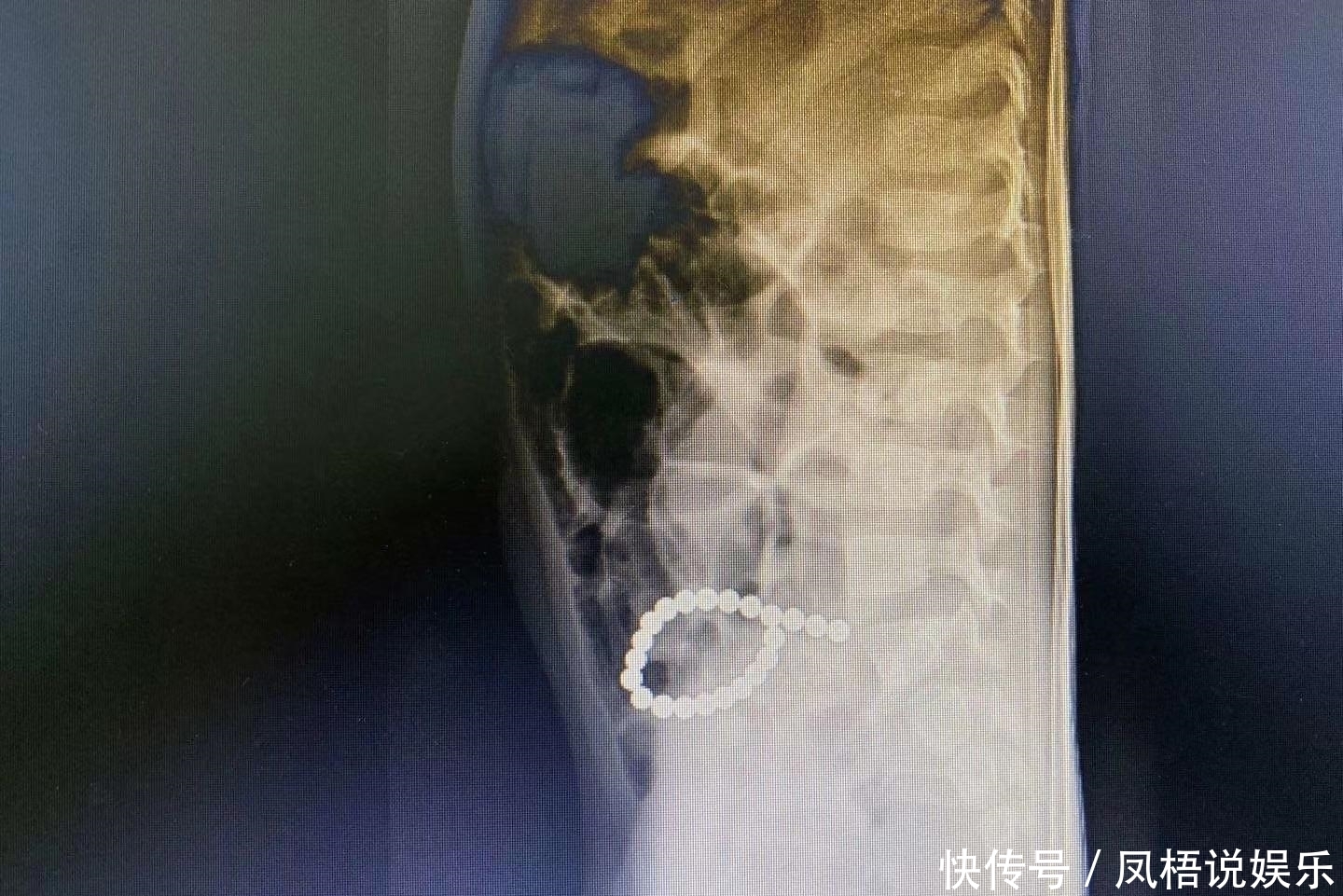 误食|3岁男童误食22颗巴克球,小肠8处穿孔 医生建议:14周岁以下别玩