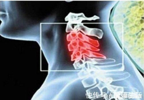 颈椎|颈椎安康:得了颈椎病不要怕,四个防护方法助您保护您的颈椎