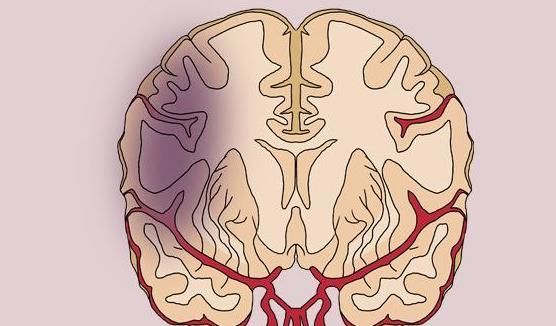  血压高|血压高患者，头部频繁有“异象”，要多提防脑梗