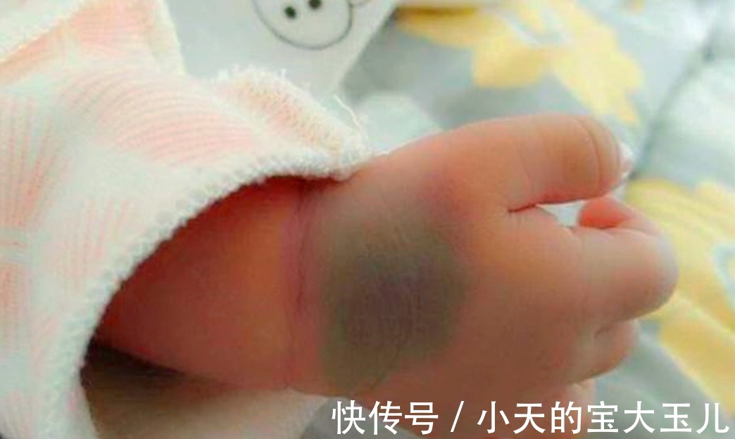 化妆品|婴儿身上为什么会有胎记？资深医生说出原因，与“孕期行为”有关