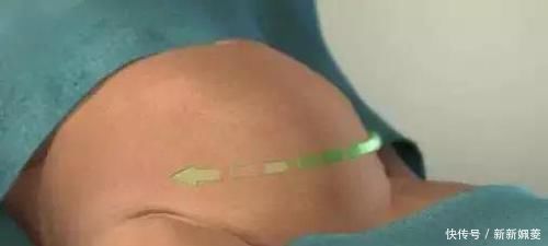 妈妈|剖腹产到底是怎么“剖”的一组图看清全过程,每个妈妈都是超人