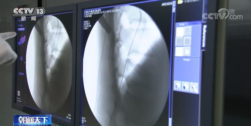 人工关节|国家组织人工关节集中带量采购 本次国家集中带量采购有哪些新变化?