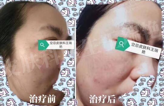 后果|全民护肤日：这些后果严重的皮肤病，却常常被忽视