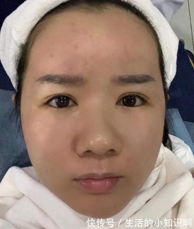 痤疮 做医美能把皮肤做好吗!