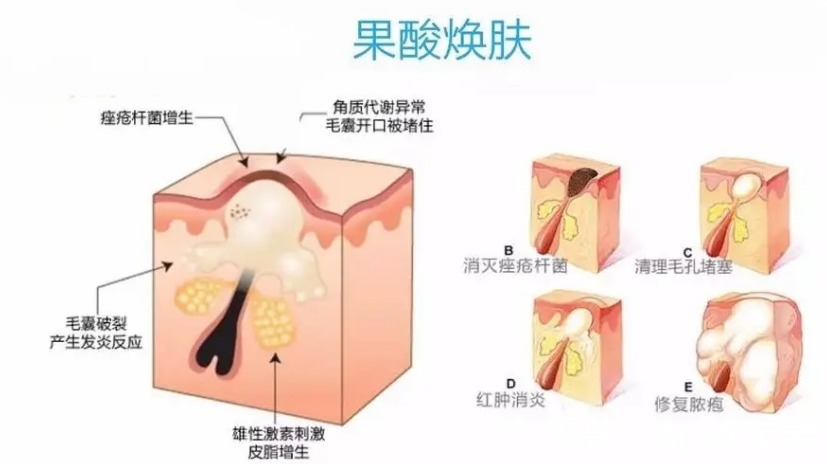 痤疮 怎么去痘|日常战痘还不够,4种医美光电项目来帮你get干净皮肤!