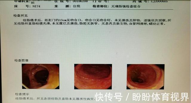 结直肠癌|出现便血,是肠癌还是痔疮?医生教你从三方面辨别,别再混淆了