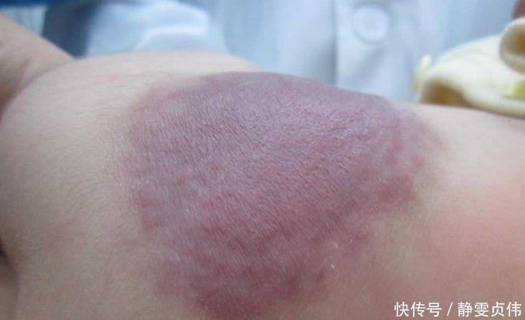 先天性|那个脸上有“蝙蝠”胎记的女孩,如今生活的怎么样?看完很欣慰