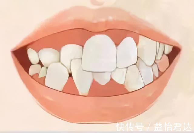 不良习惯|孩子12岁前必须处理的牙齿问题!家长都了解吗?
