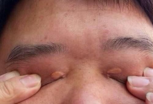 溶解剂|糖尿病“溶解剂”大公开!不是洋葱,坚持吃或能降低血糖