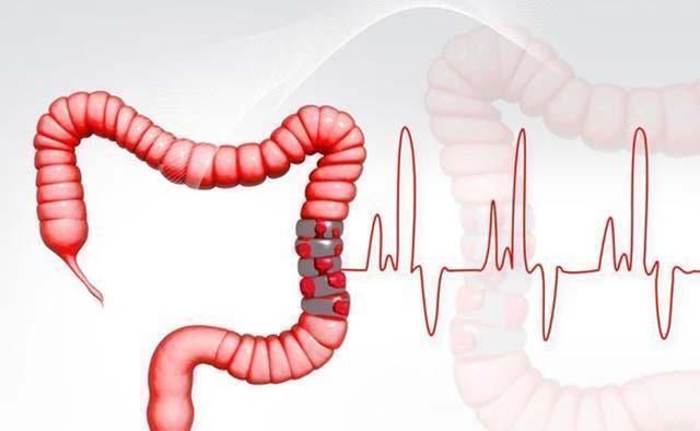 远处转移|大肠癌会有五个标志，超过三个以上，提示肿瘤已经不是早期
