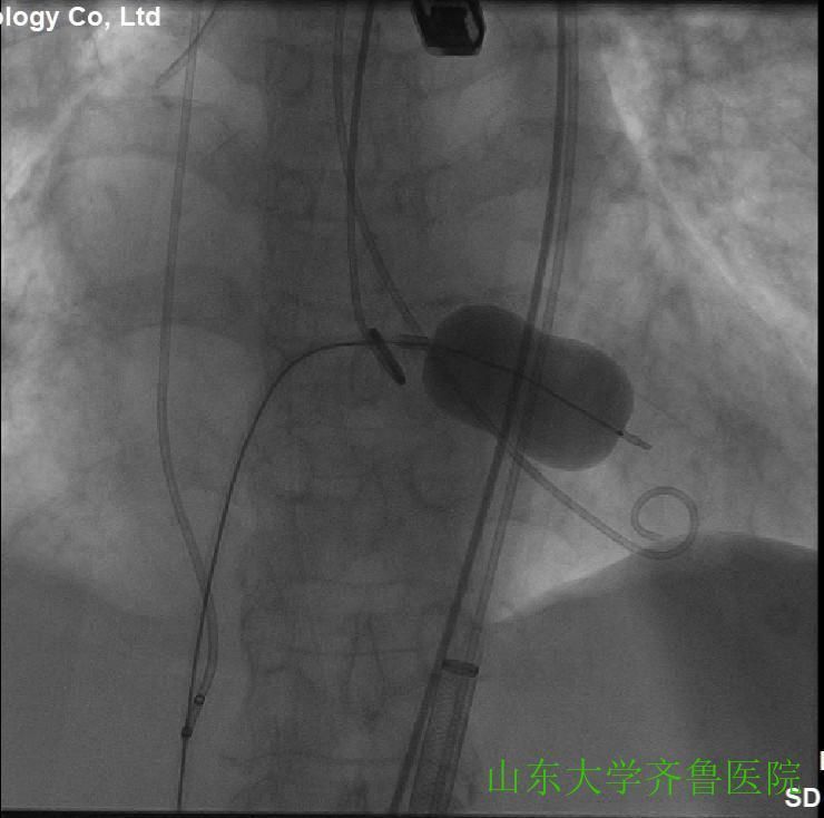 患者|省内首例!齐鲁医院完成一站式经导管主动脉瓣置换术(TAVR)+经皮二尖瓣球囊扩张成形术(PBMV)