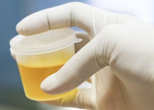 肾功能|上厕所时,尿液“发黄有异味”,并非上火,或是身体在“求救”!