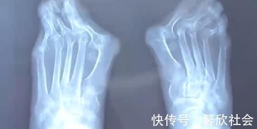 女性 爱穿高跟鞋的女性一定要小心,拇指外翻堪比“裹脚”!不可忽视