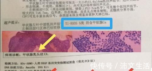 超声|甲状腺结节会是癌吗?需要做哪些检查?基因检测有什么用呢?