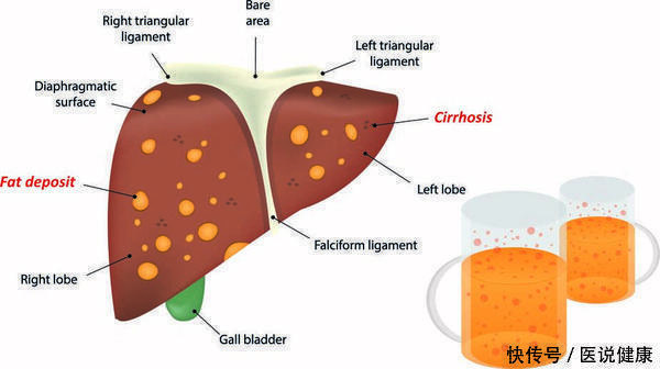 肝细胞|哪些人群是肝癌的“候选人”？医生：这5个特点请对号入座！
