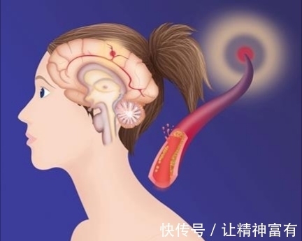 高血压者|男子晕倒入院,脑梗要重视,医生直言:高血压者有4个表现要重视