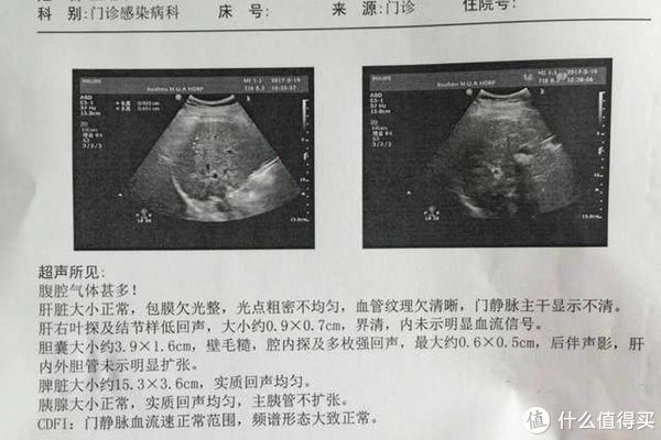 病变|颈椎病、脂肪肝,中年人需时刻警惕的2种危险疾病