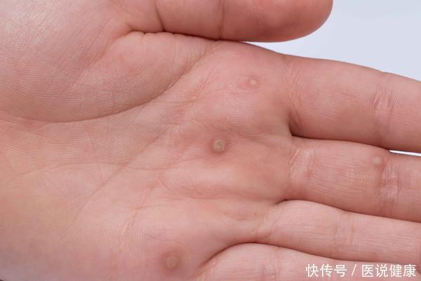 高发|5月份手足口病易高发,提醒家长:预防孩子感染,请做好这4点!
