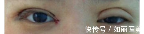 手术 什么样的双眼皮手术意味着失败了?术后多久才能进行二次修复?看完这篇,你就知道啦~
