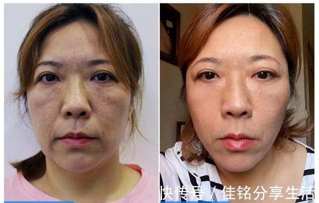 手术 52岁阿姨分享拉皮手术的真实心路历程!
