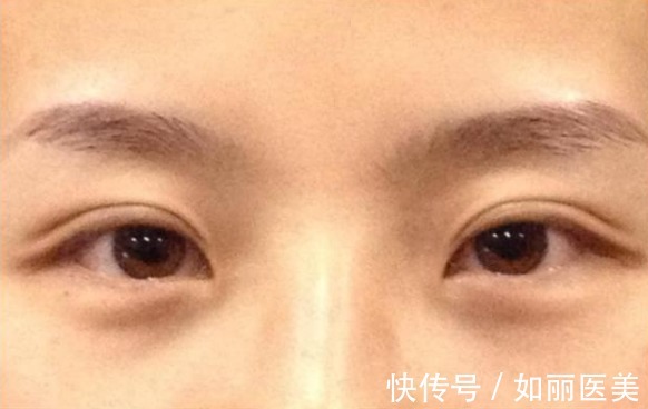 经验 做过全切双眼皮手术的"过来人",分享10条最实用的经验