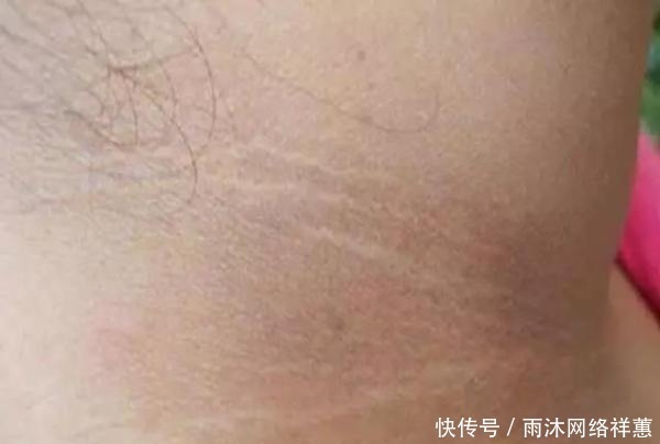 脖子|十岁小男孩脖子一圈发黑洗不掉，听了医生的话后，家长们都笑了