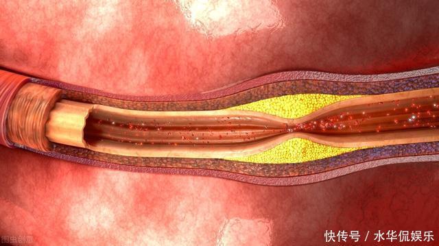 中年人患三高先别慌，饮食上坚持3不吃，血脂、血压、血糖稳稳降