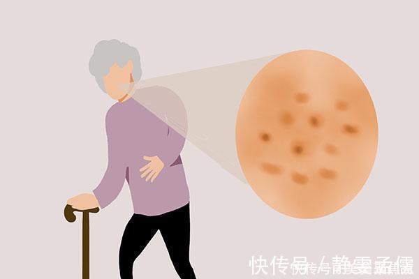 干性|老年斑是怎么来的,同样50岁,为何有人脸部没斑,有些人却很多