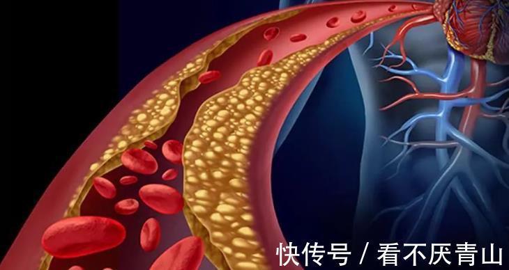 植物蛋白|豆制品是高血脂“发物”?提醒:缓解血脂升高,3种素食建议少吃