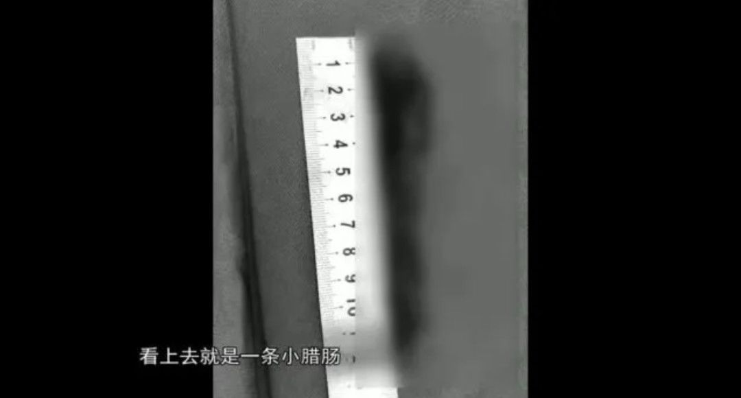 腰椎间盘突出|阿姨腰痛十来年，体内竟长出一条“广式腊肠”险截瘫！医生紧急提醒