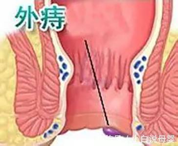 便血|痔疮的症状表现有哪些?缓解痔疮问题,这两步就行!
