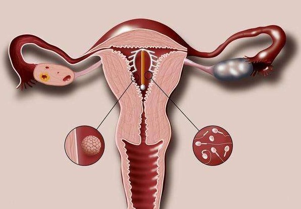 腰酸背痛|当年很火的“上环”,如今为何销声匿迹别再让爱人“上环”