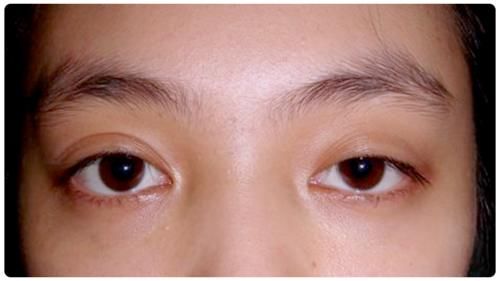 逼疯强迫症的一单一双眼皮，手术能不能只做单侧？