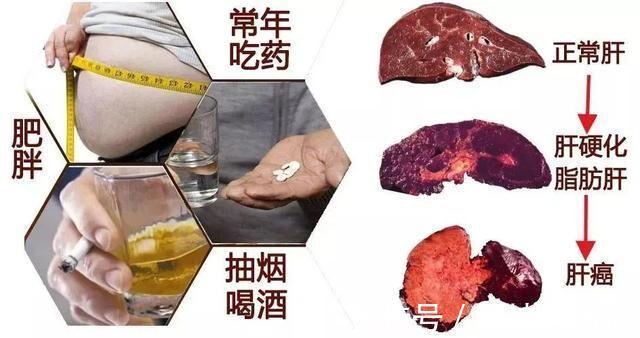 消化道出血|肝不好的人，上厕所通常会有3种表现，若没有，恭喜你肝很健康