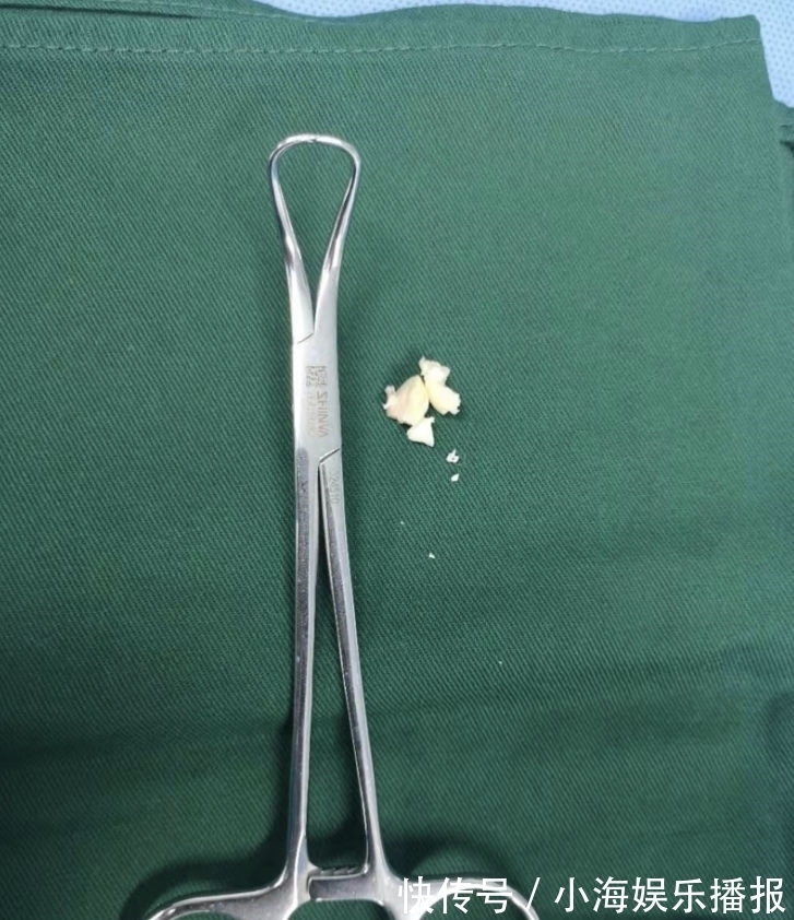 麻醉科|1岁男童被花生堵住气管,医护联合成功取出异物