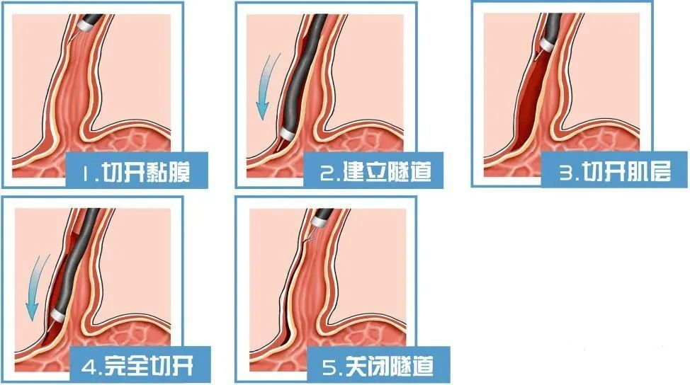 内镜|七年吞咽困难！新式内镜技术（OPEN-POEM手术）十分钟顺利解忧