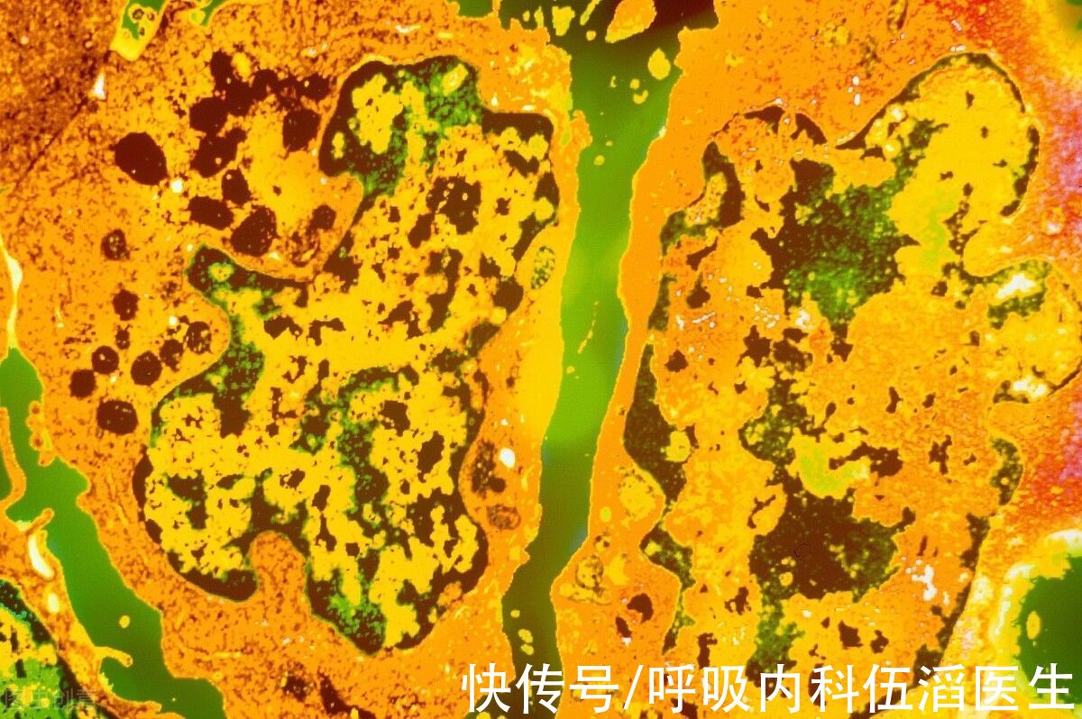 化疗|自从确诊了肺癌晚期后，他已坚持5年：癌症其实没什么大不了？