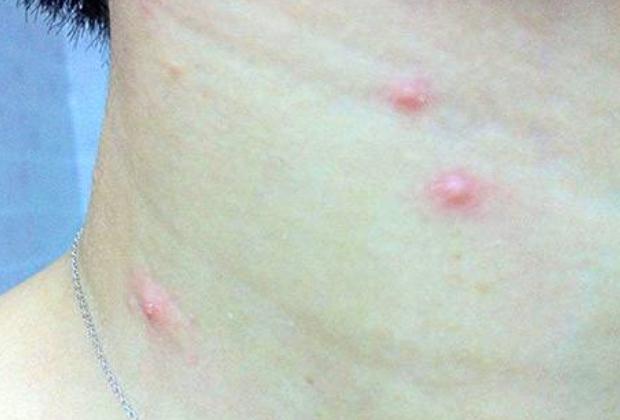 身体|脖子上长出了“小肉粒”是什么也许是身体向你发出的“暗号”