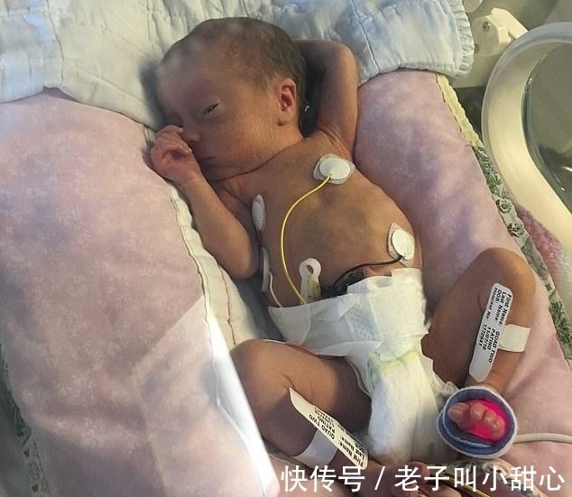 洛根|70万分之一!英国最小四胞胎弟弟出生仅1.2斤,住院9个月后迎来生日