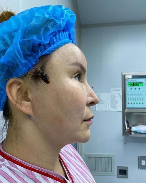 不到50岁就老成大妈？小拉皮术后6个月轻松实现逆生长！