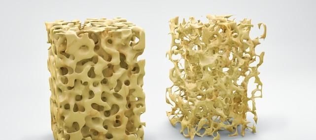 磷酸|骨科医生直言：3个月坚持吃2物，腰背不疼，骨质疏松不上门