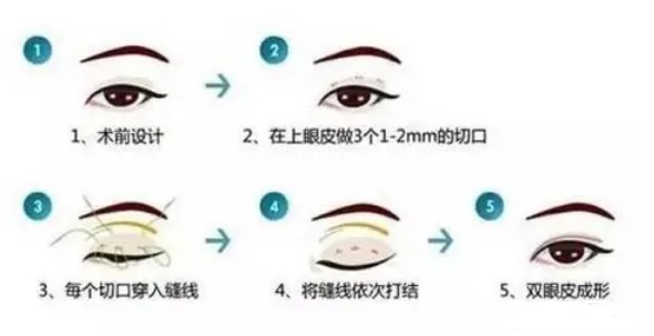 埋线双眼皮 割双眼皮需要多少钱?原来手术方式不一样价格也不同!快来看看你割双眼皮需要多少钱?