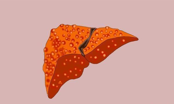 中年|医生多次劝告三类食物要少碰,和肝癌走得比较近,最好一口不吃