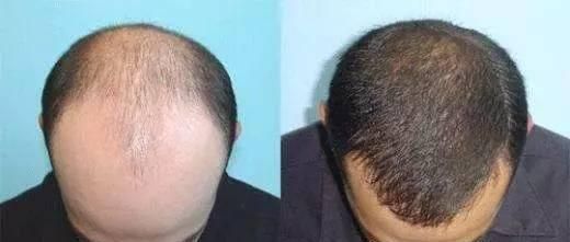 种植|天生发际线高还有救吗?试试发际线补发和自体头发种植,非常实用