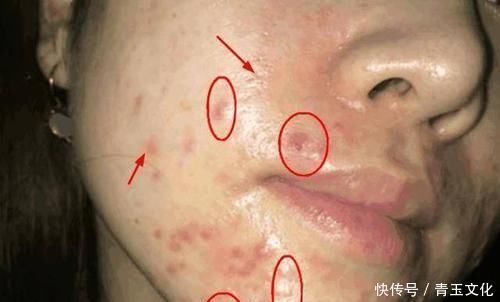 毛孔越来越大，是螨虫把你的脸当成寄宿地，3个方法教你摆脱困扰