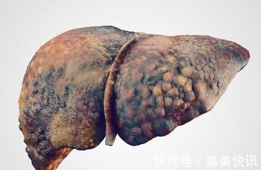 肝细胞|肝硬化的“克星”找到了，经常吃一点，修复肝细胞，肝癌不来找！