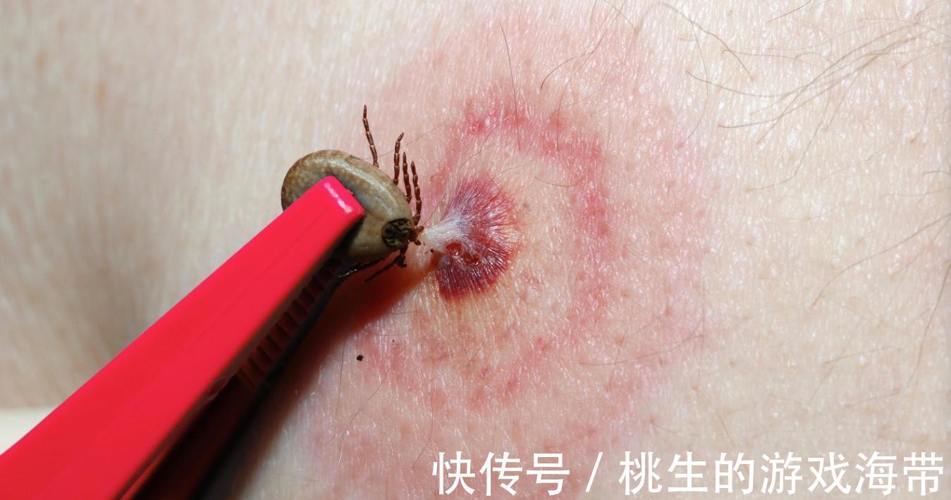 医生|夏天蜱虫多，孩子被咬后别硬拔，宝妈学会三个急救法，医生都夸好