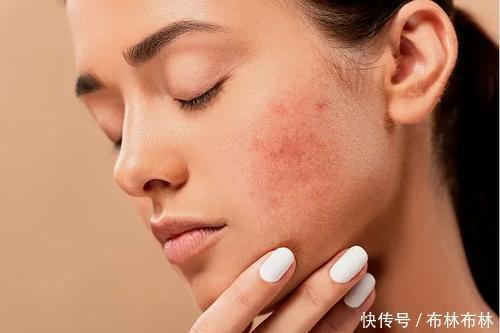 皮肤过敏|避免红肿发炎,舒缓敏感肌,护肤补水是关键