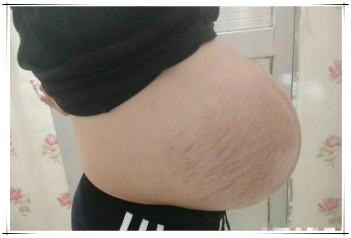 孕妇|孕妇“悬垂肚”走红,网友猜测是“双胞胎”:没见过这样的孕肚